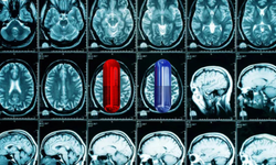 Beyin sisini dağıtacak mı? Yeni Alzheimer ilacı test ediliyor