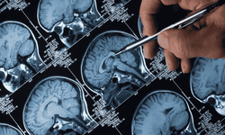 Alzheimer tedavisinde yeni umut