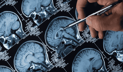 Alzheimer tedavisinde yeni umut