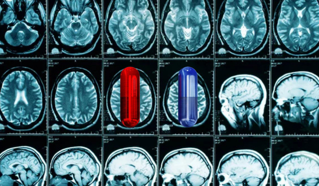 Beyin sisini dağıtacak mı? Yeni Alzheimer ilacı test ediliyor